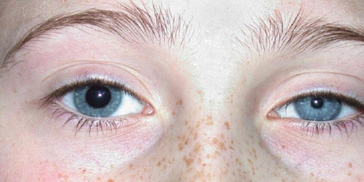 تفاوت اندازه مردمک چشم در حالت عادی و پاتولوژیک و تأثیر آنها بر درک نور