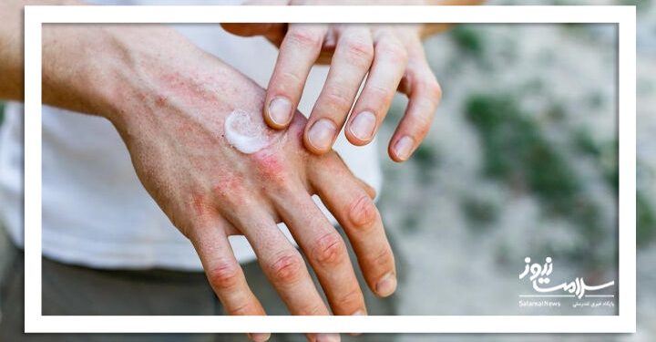 چطور اگزما می‌تواند باعث شود سالم‌تر غذا بخورید؟