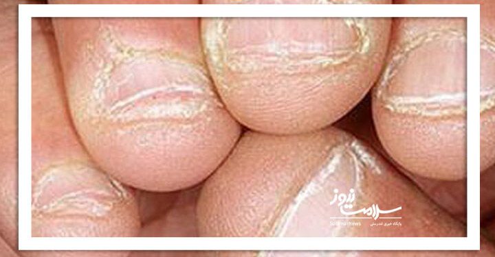 چرا دور ناخن پوسته پوسته میشود؟
