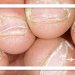 چرا دور ناخن پوسته پوسته می‌شود؟