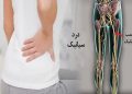 سیاتیک را با گرفتگی عضلات اشتباه نگیرید