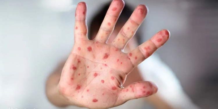 طغیان سرخک در برخی نقاط کشور، پناهجویان در افزایش آمارها بی‌تاثیر نیستند