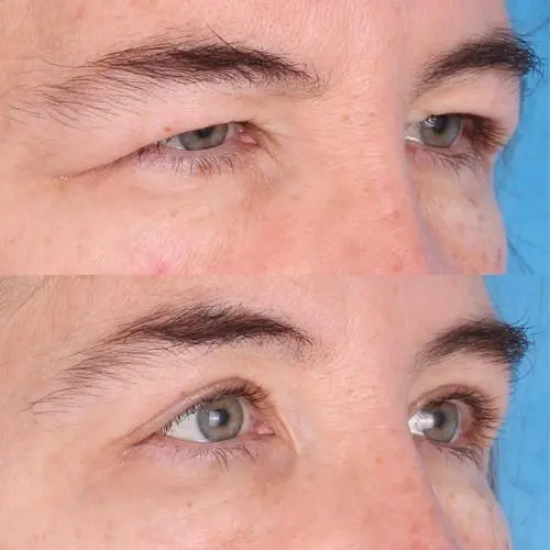 بلفاروپلاستی در مشهد